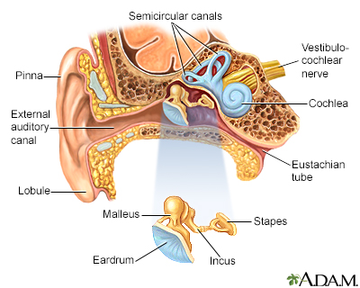 Otosclerosis