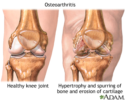 a jobb bokaízület osteoarthritis