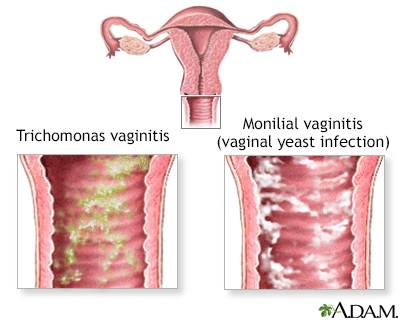 Enterobius vermicularis vulvovaginitis, Oxyuriasis