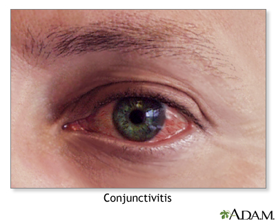 allergic conjunctivitis cold compress