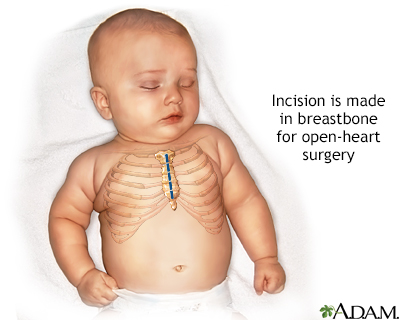 Congenital Heart Defect Corrective Surgery