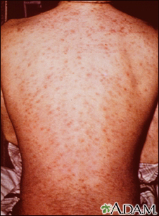 Carbamazepine Rash Photos