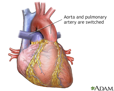 Transposition Of The Great Arteries