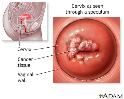 Taking a Look at Cervical Cancer