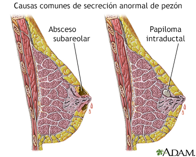 que es una papiloma en el seno)