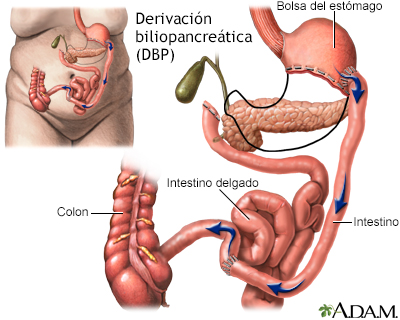 Sindrome Del Asa Ciega