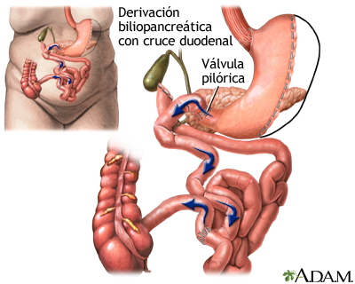 Cirugia De Derivacion Gastrica