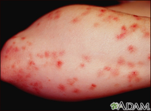 Dermatitis herpetiformis – az autoimmun gluténérzékenység tünete