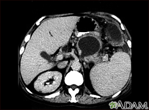 Pancreatic pseudocyst